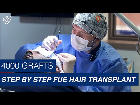 Step by Step FUE Hair Transplant | 4000 Grafts