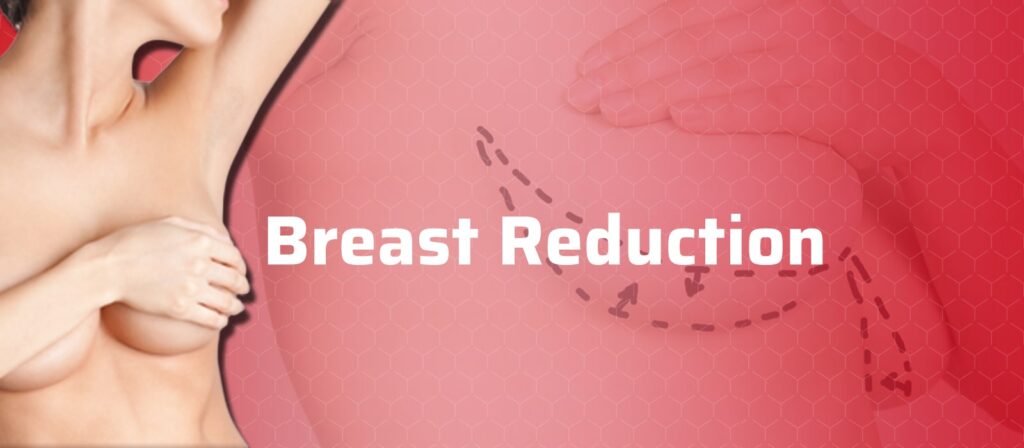 Breast Reduction - Novemedical