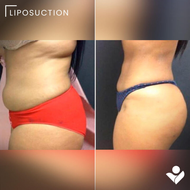 Liposuction1A