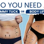 Do You Need A Tummy Tuck or Body Lift?