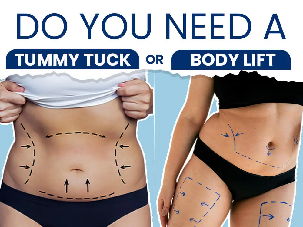 Do You Need A Tummy Tuck or Body Lift?